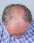 Before Hair Transplant&nbsp;Front